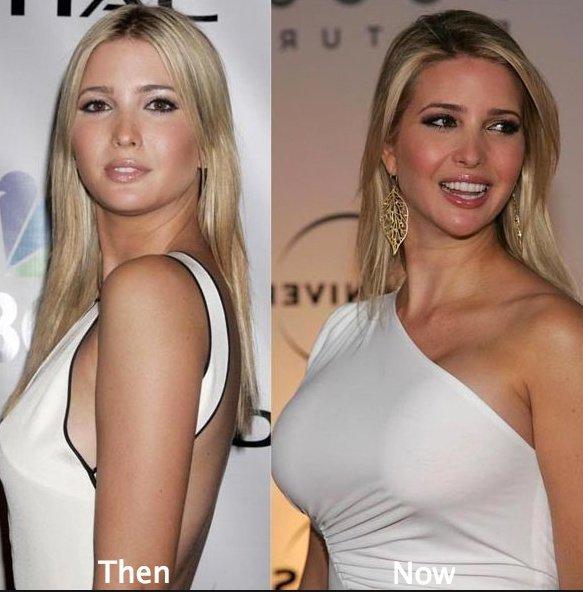 Natrual boob job before and after