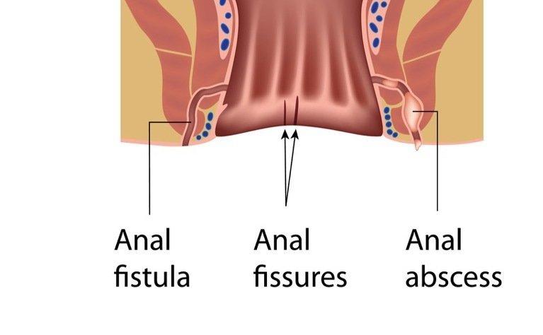 Daffy reccomend Nhs abcess anal fistula