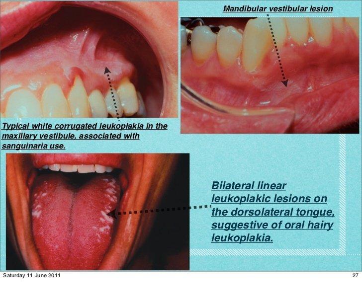 best of Hairy cause Oral leukoplakia
