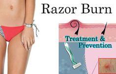 best of Razor bikini Preventing burn/bikini bumps when area shaving