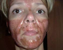 best of Damage caused peels Skin by facial