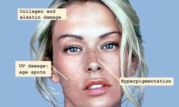 Skin damage caused by facial peels