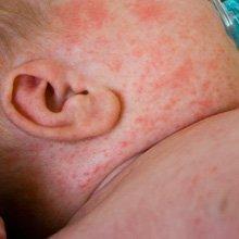 Treating newborn facial rash
