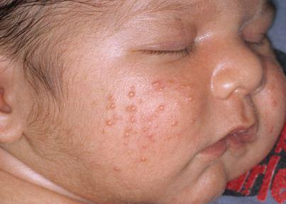 best of Rash facial Treating newborn