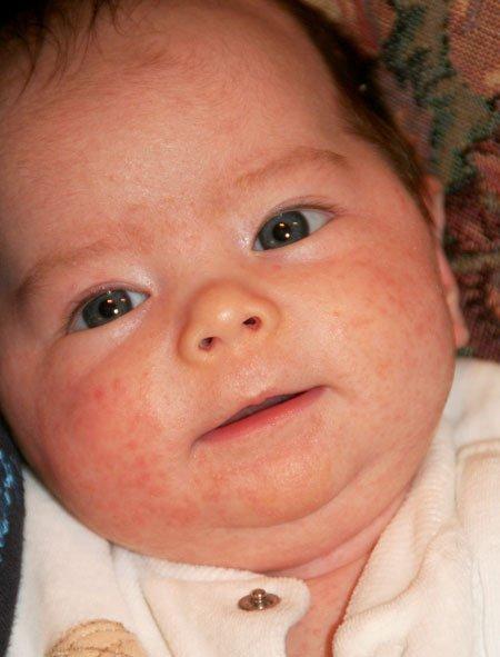 Coma reccomend Treating newborn facial rash